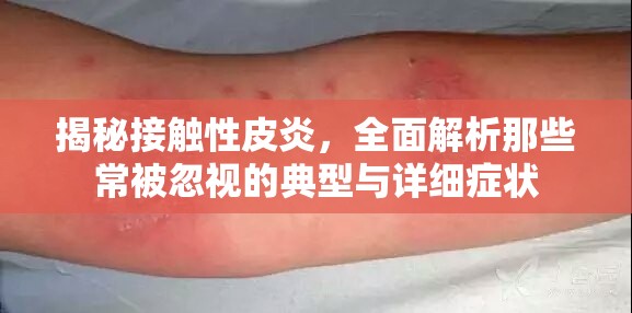 揭秘接触性皮炎，全面解析那些常被忽视的典型与详细症状